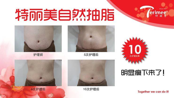 MULTI (II) LIPO SLIMMING PLASTY -M