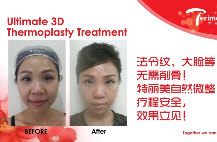 MICRO AESTHETICS350-(NON SURGERY,NON INJECTION)自然V微整